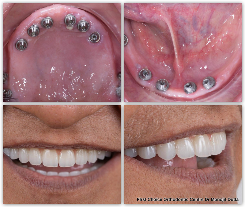 All-on-4 Implants 2