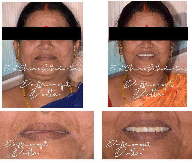 All-on-4 Implants