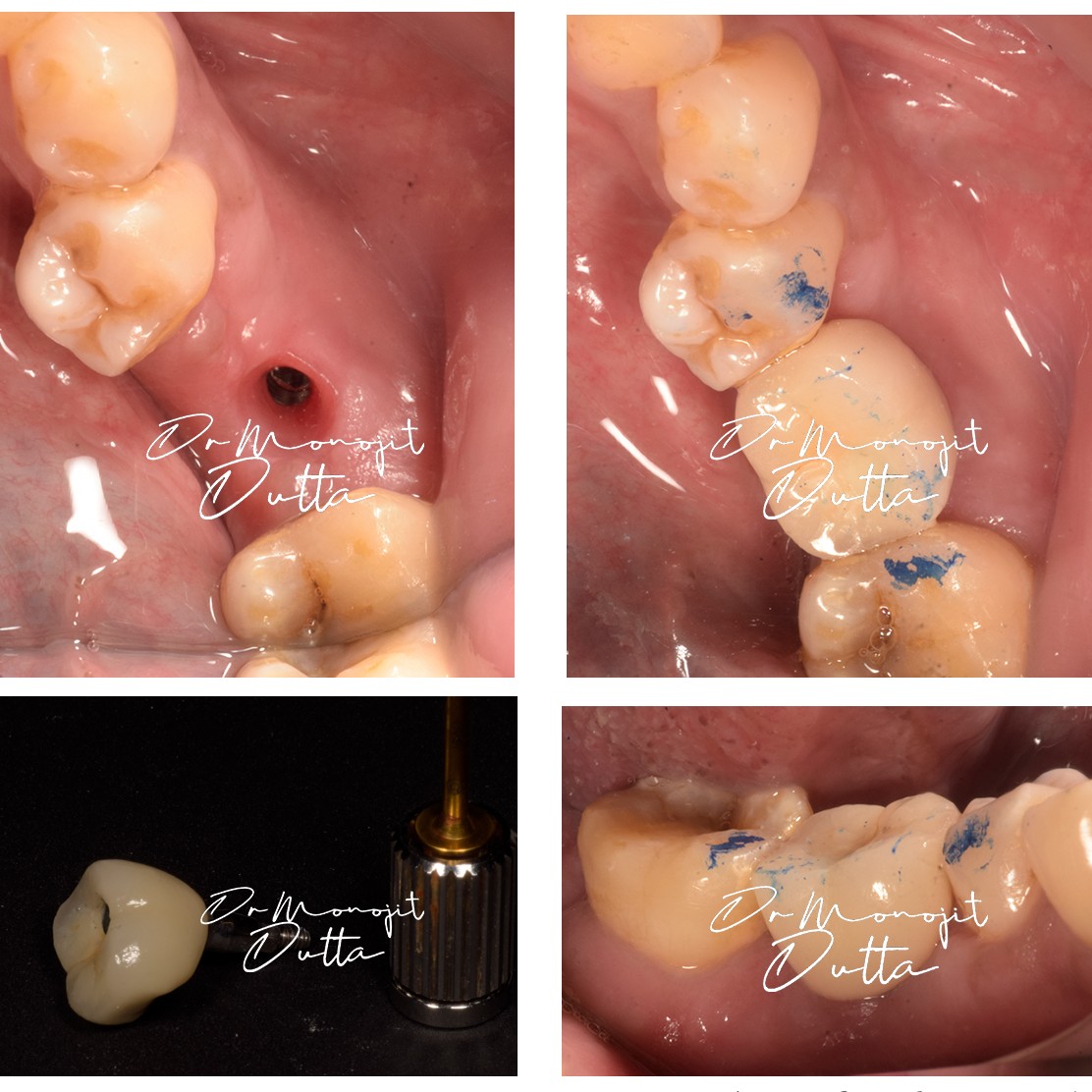 Dental Implant Before and After 1